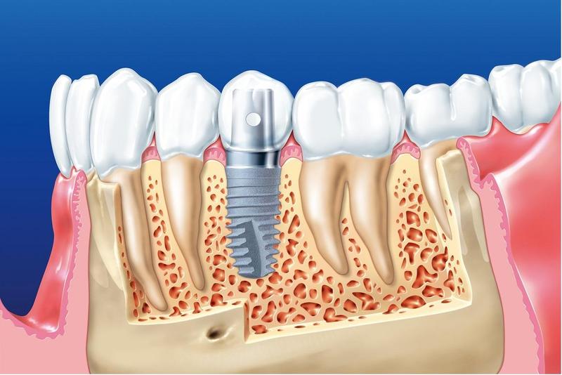 Nha khoa trồng răng implant uy tín nhất Thái Bình