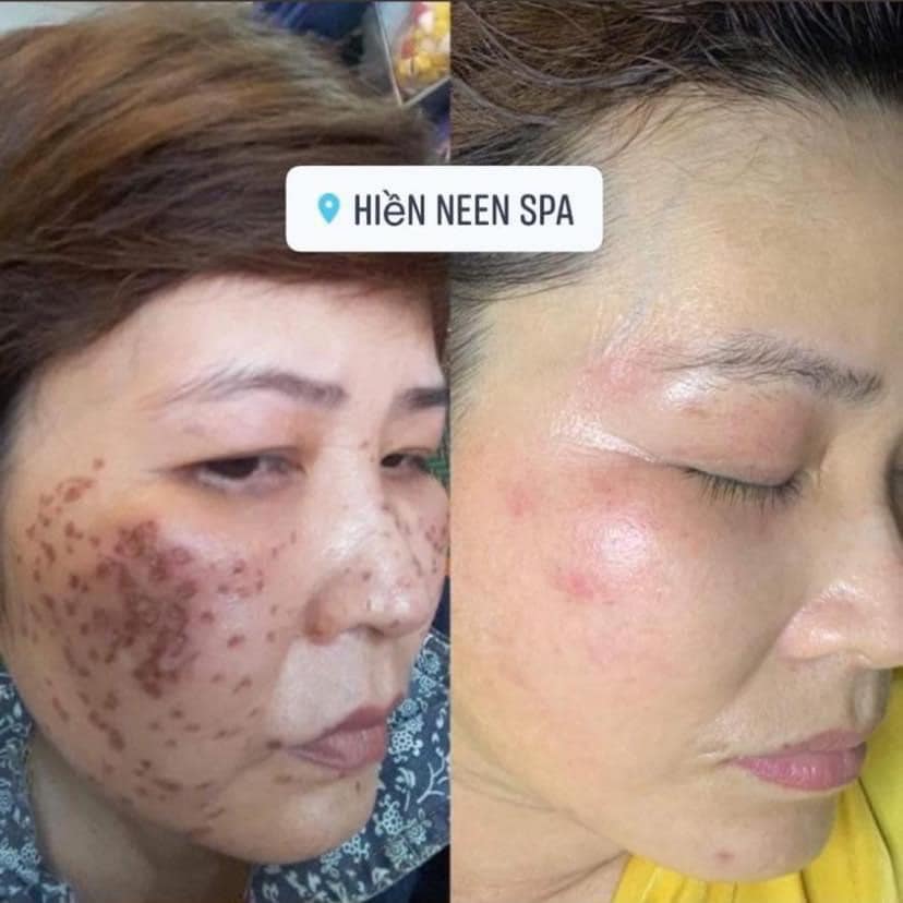 Hiền Neen Spa ảnh 2