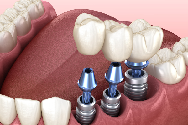 Địa chỉ trồng răng implant tại Quận 10, TP HCM uy tín nhất