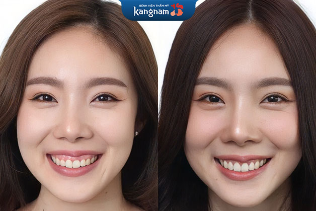 Địa chỉ chữa cười hở lợi uy tín nhất tại Hà Nội