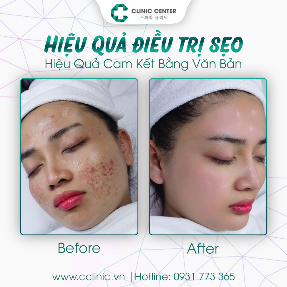 C Clinic Center - Điều trị Sẹo Rỗ ảnh 1