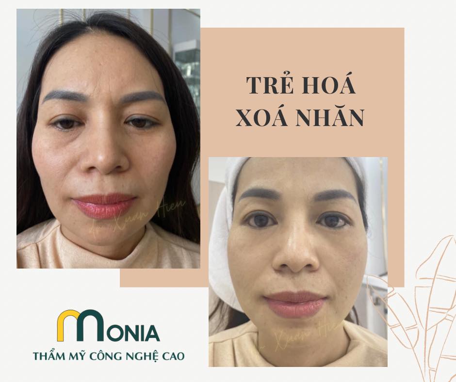 Thẩm mỹ công nghệ cao Monia ảnh 2