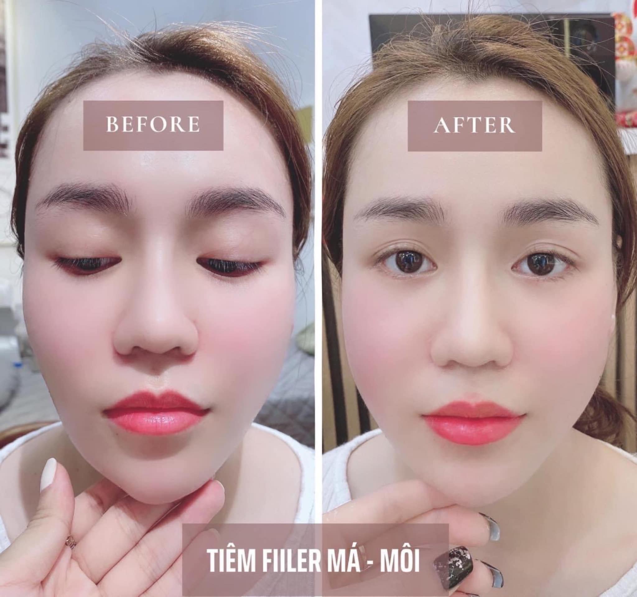 Địa chỉ tiêm filler - botox uy tín và chất lượng nhất Thái Nguyên