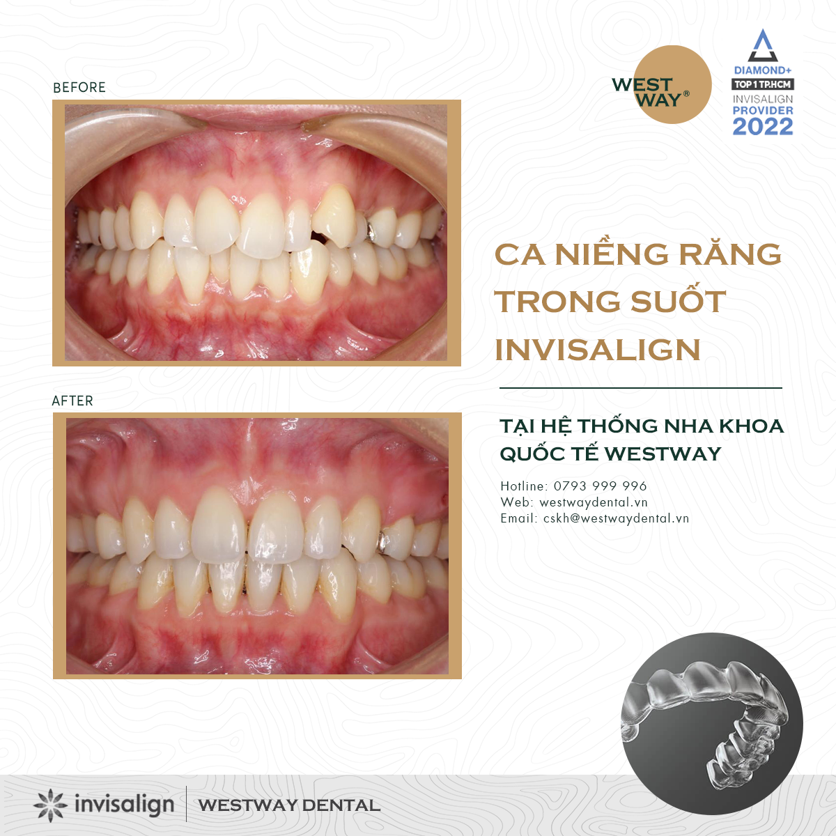 Westway - Niềng Răng Chuẩn 5 Sao ảnh 2