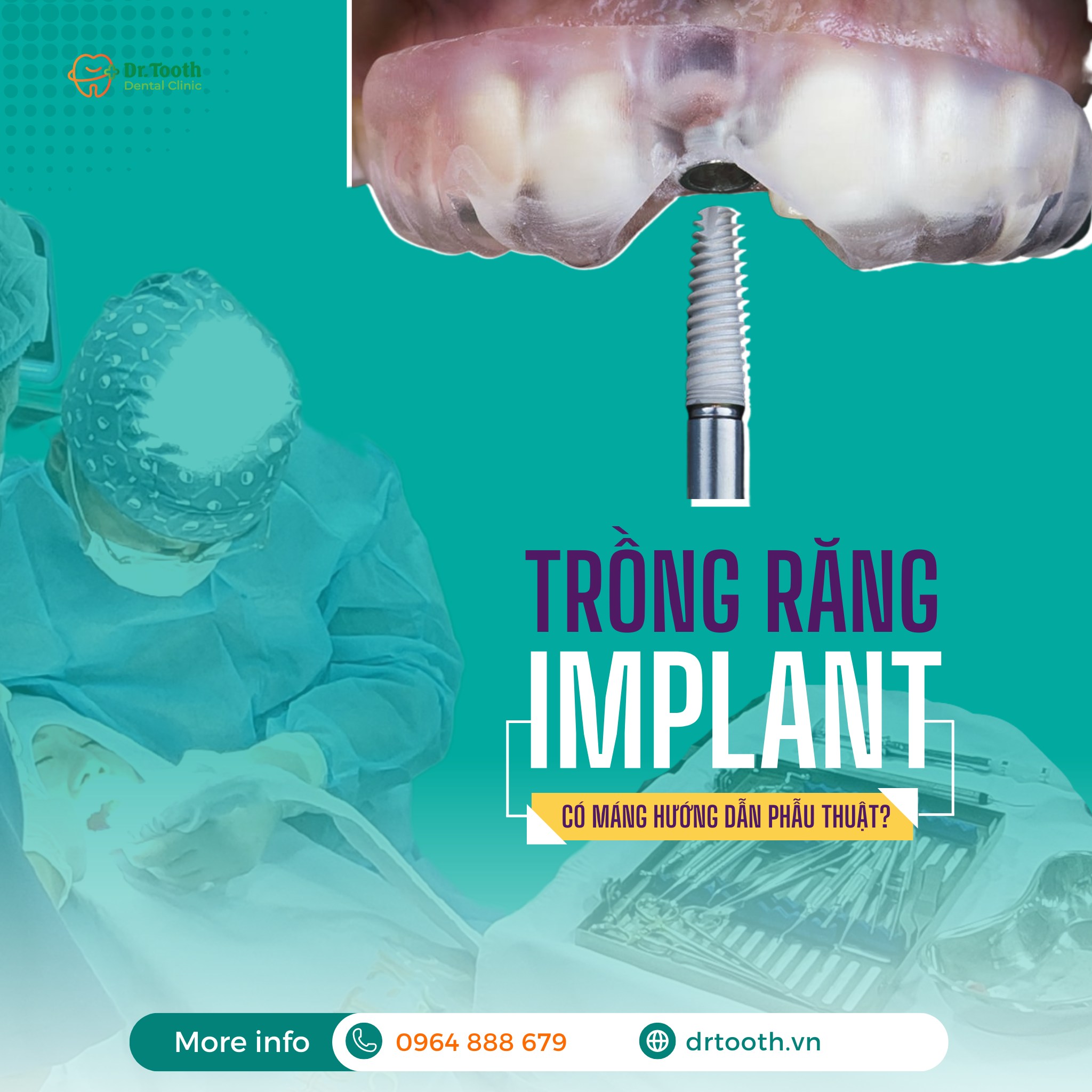 Địa chỉ trồng răng implant uy tín nhất Nha Trang