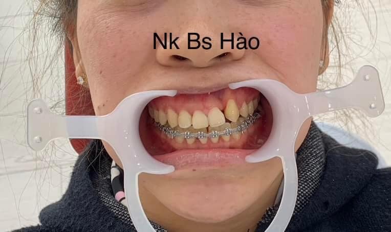 Nha khoa BS Hào ảnh 2