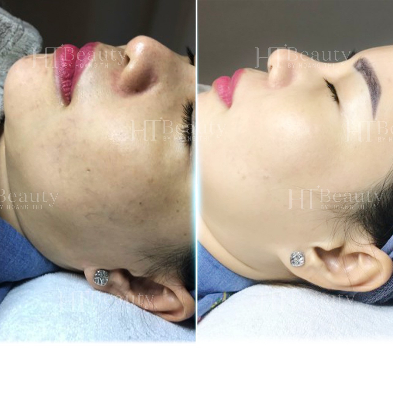 Viện Thẩm Mỹ HT Beauty ảnh 2