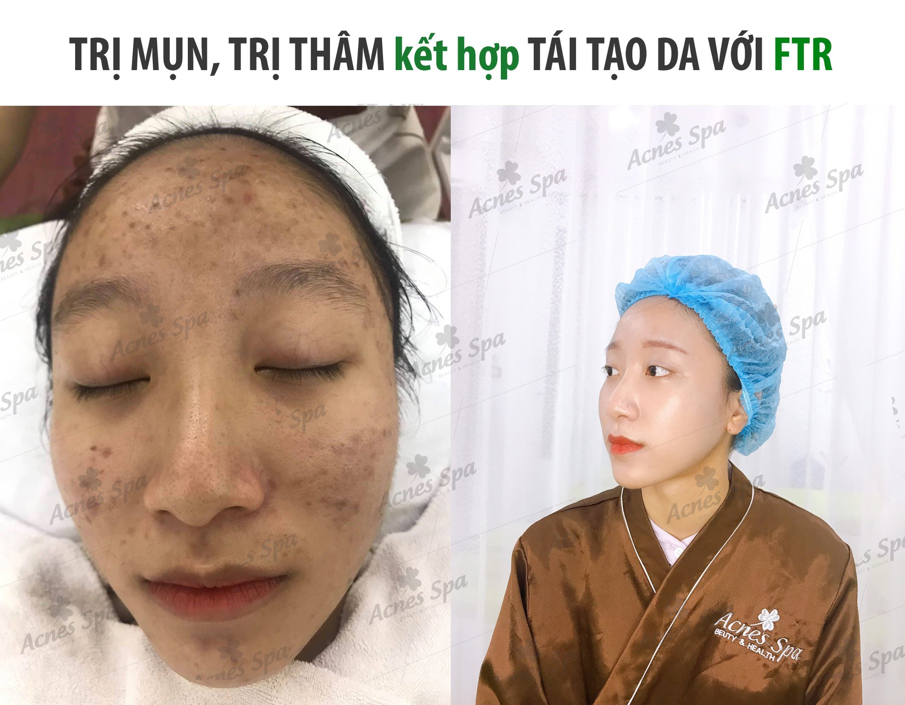 Acnes Spa ảnh 1