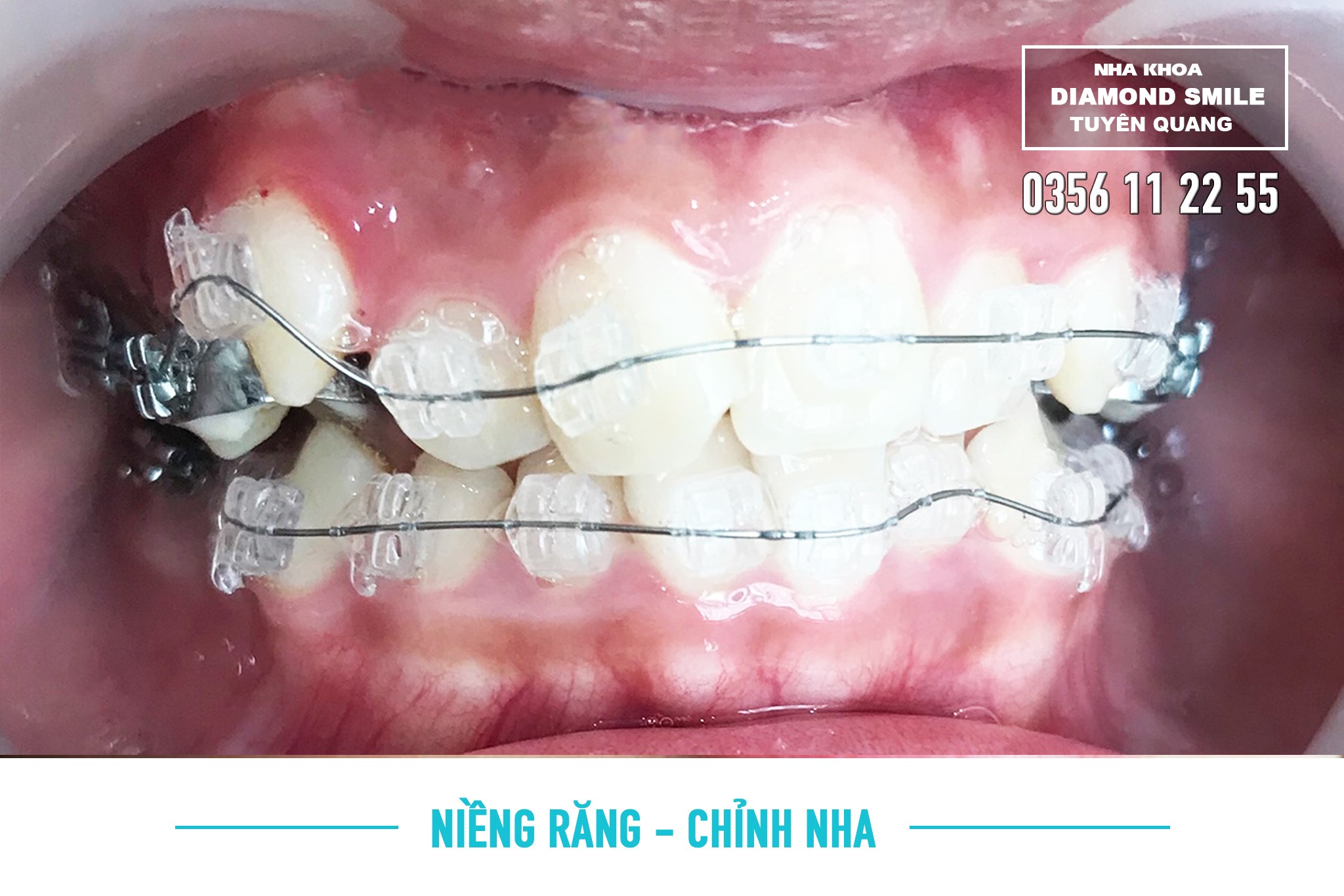 Nha khoa Diamond Smile Tuyên Quang ảnh 1