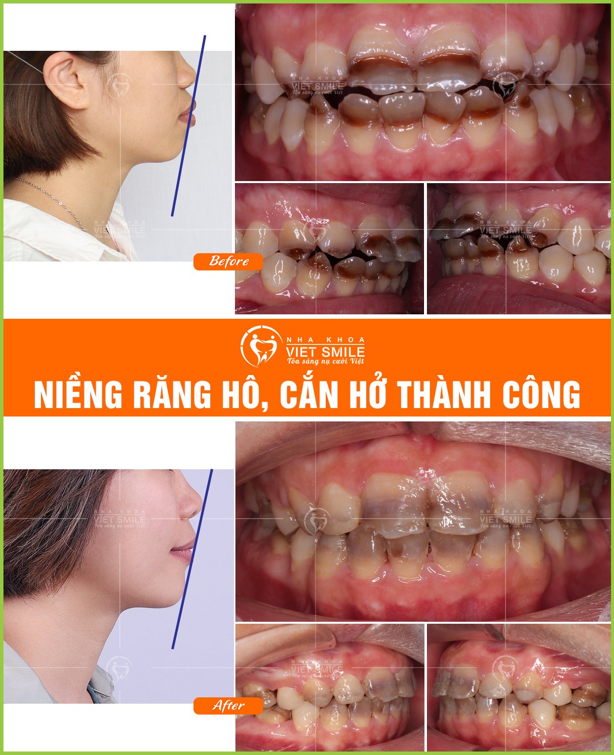 Nha khoa VIET SMILE Lào Cai ảnh 1