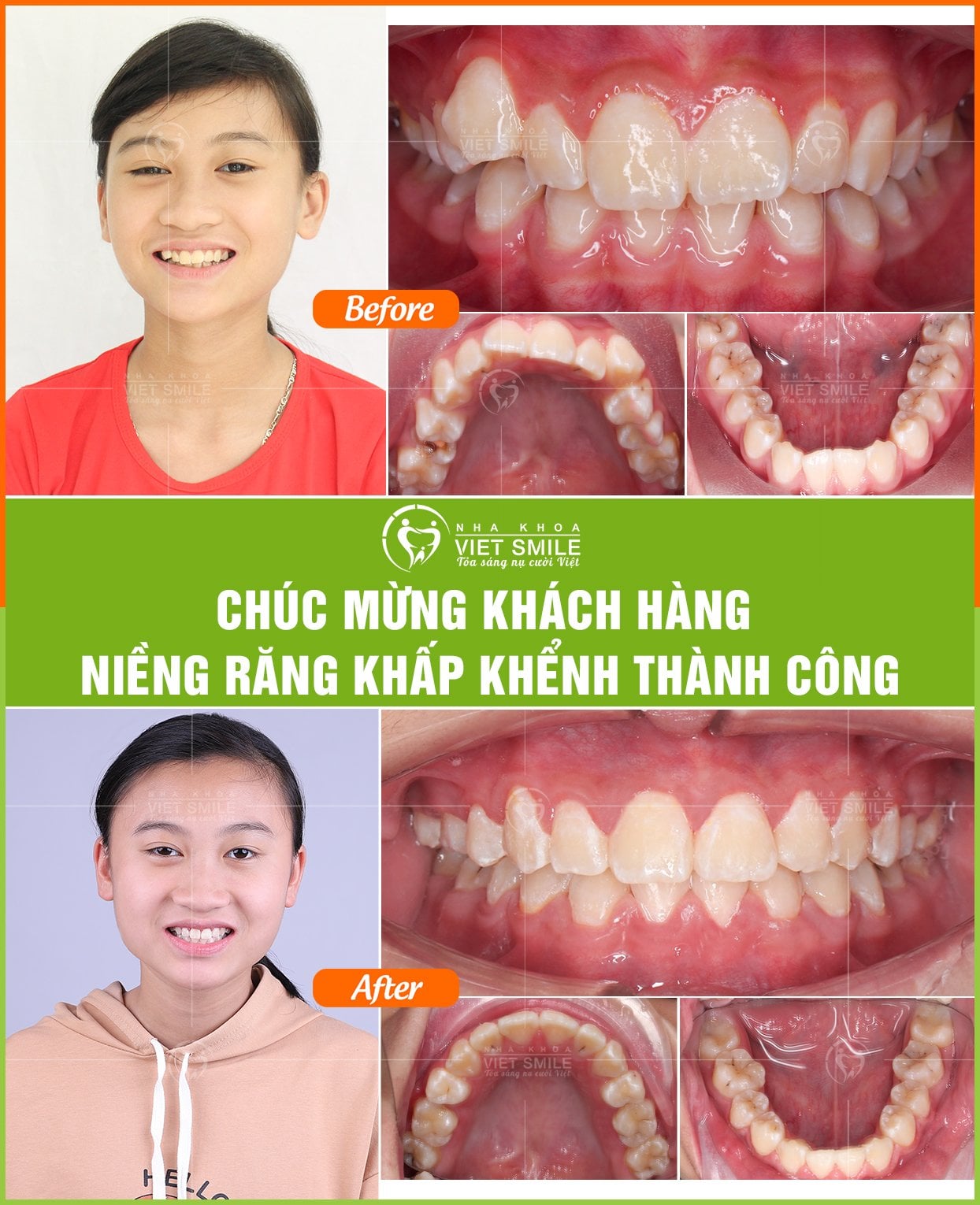 Địa chỉ niềng răng đẹp và uy tín nhất Lào Cai