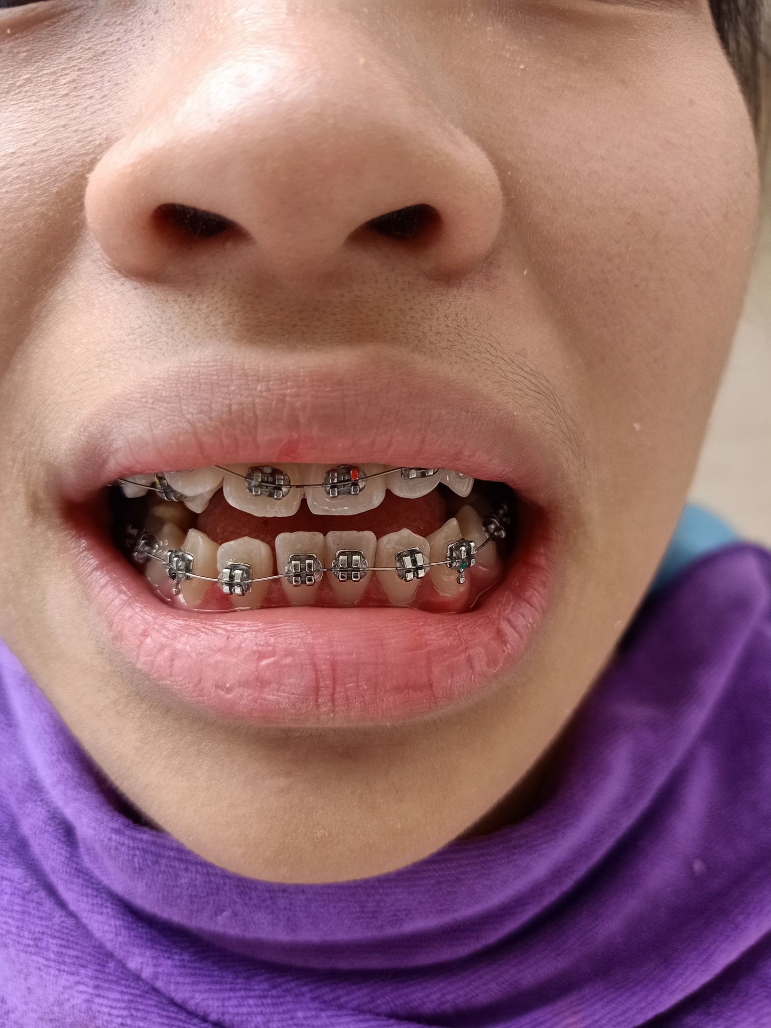 Địa chỉ niềng răng đẹp và uy tín nhất Cao Bằng