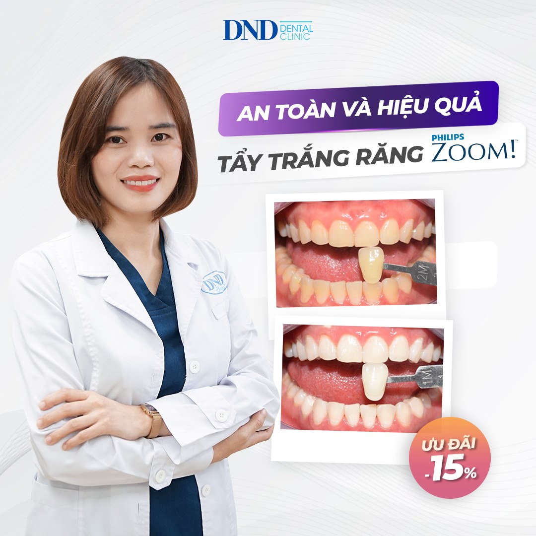 Địa chỉ tẩy trắng răng uy tín nhất quận Hai Bà Trưng, Hà Nội