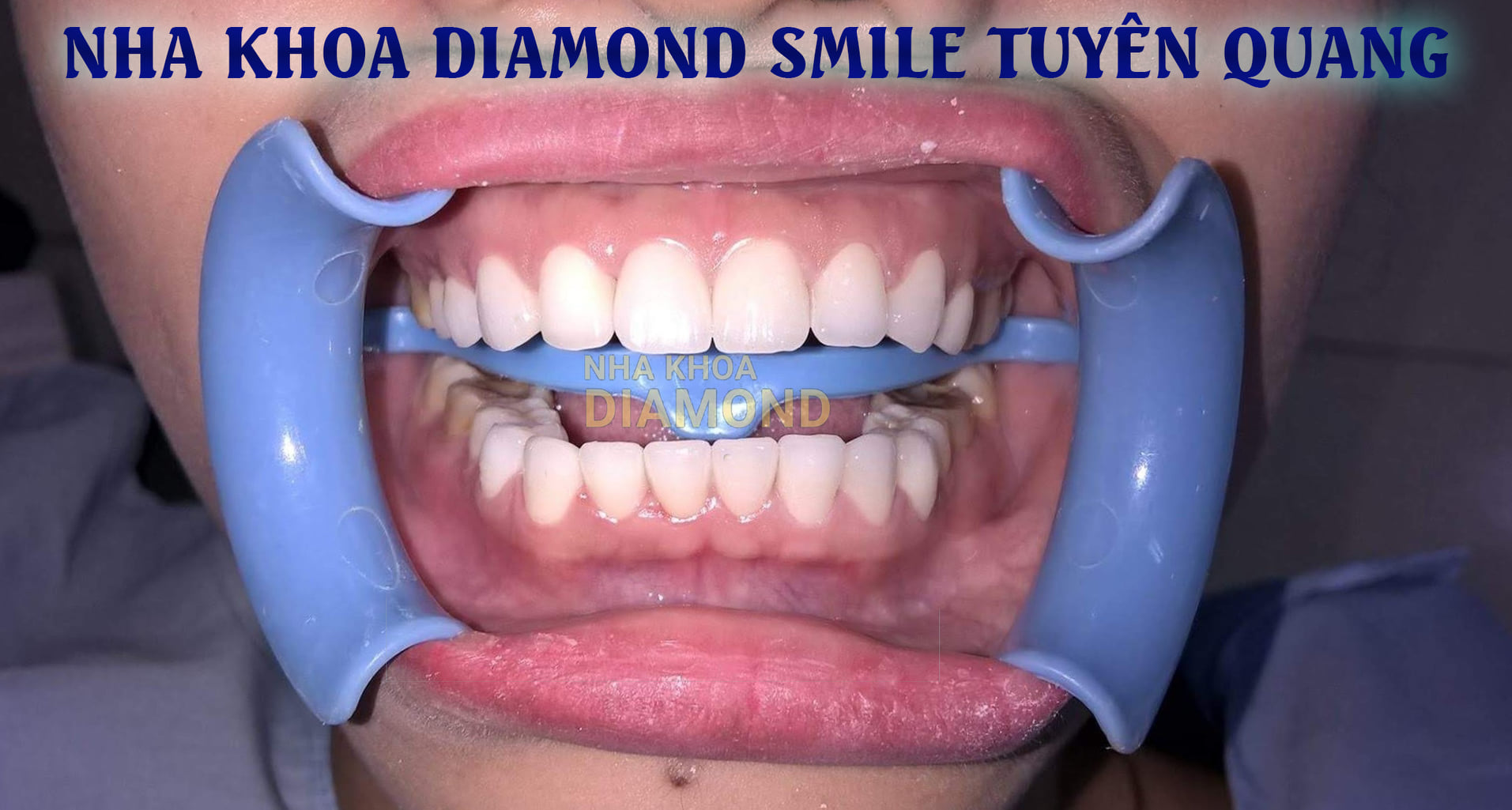 Nha khoa Diamond Smile Tuyên Quang ảnh 2