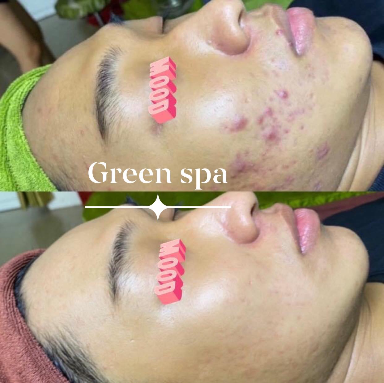 Spa trị mụn hiệu quả nhất Nhơn Trạch, Đồng Nai