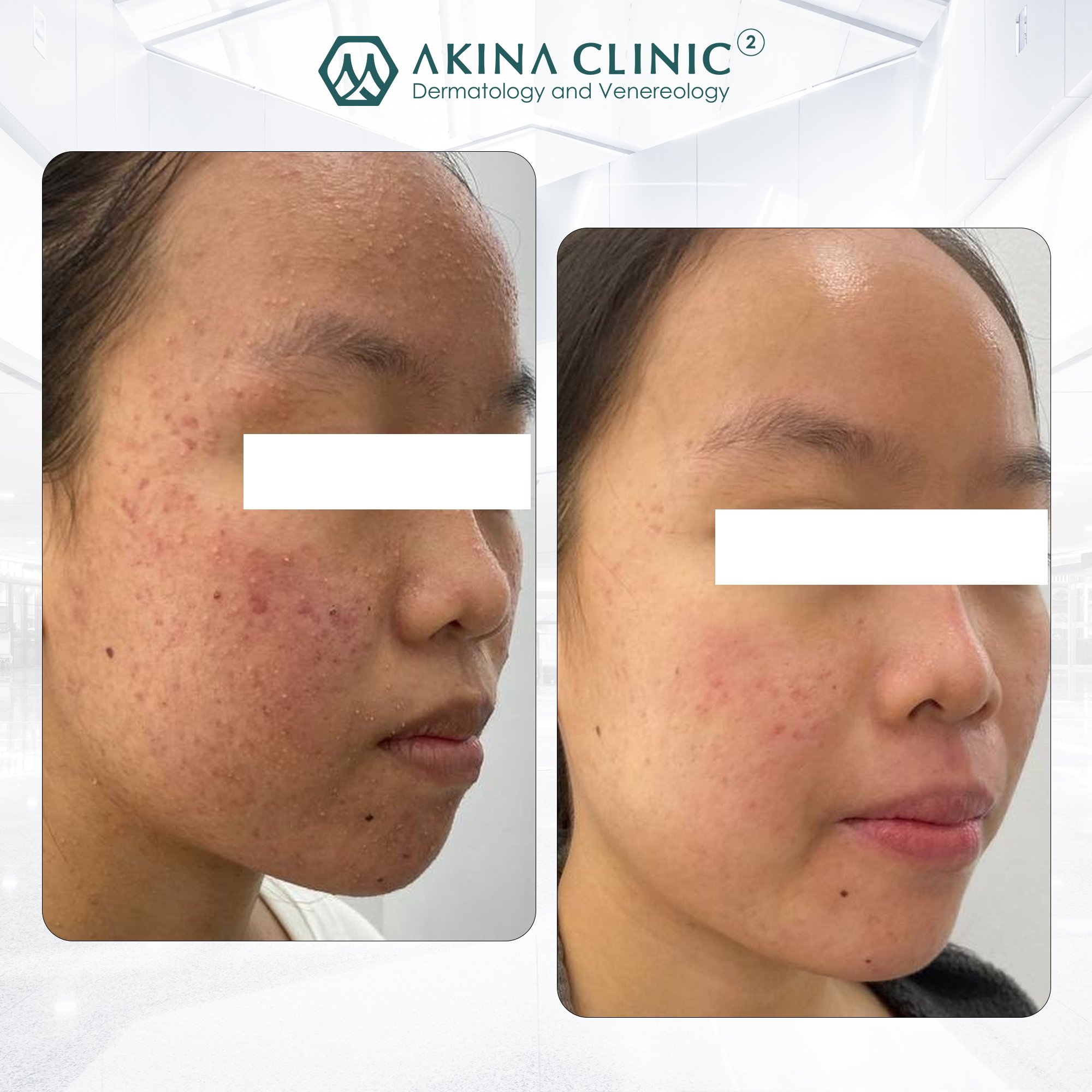 Phòng khám da liễu AKINA Acne ảnh 2