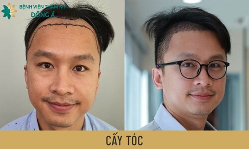 Địa chỉ cấy tóc hàng đầu tại Việt Nam ở đâu 5 tiêu chí đánh giá