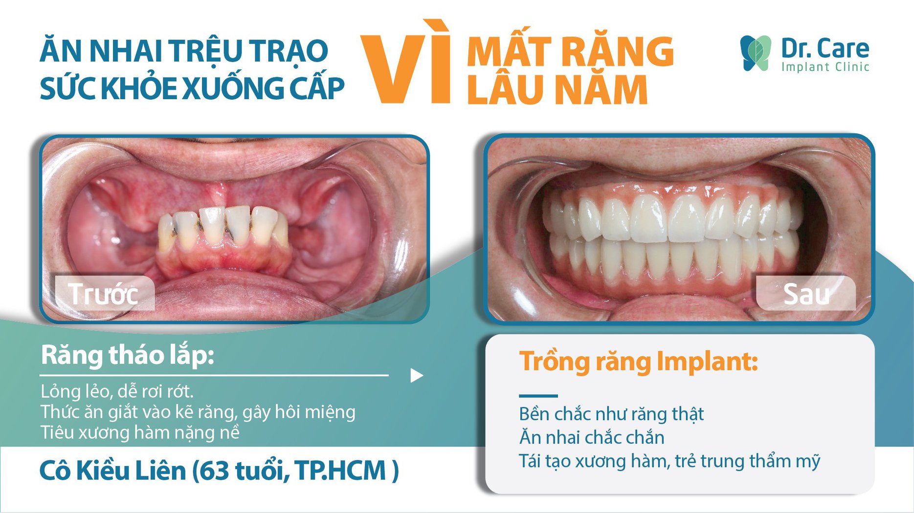 Dr. Care - Liệu Pháp Trồng Răng Không Đau ảnh 1