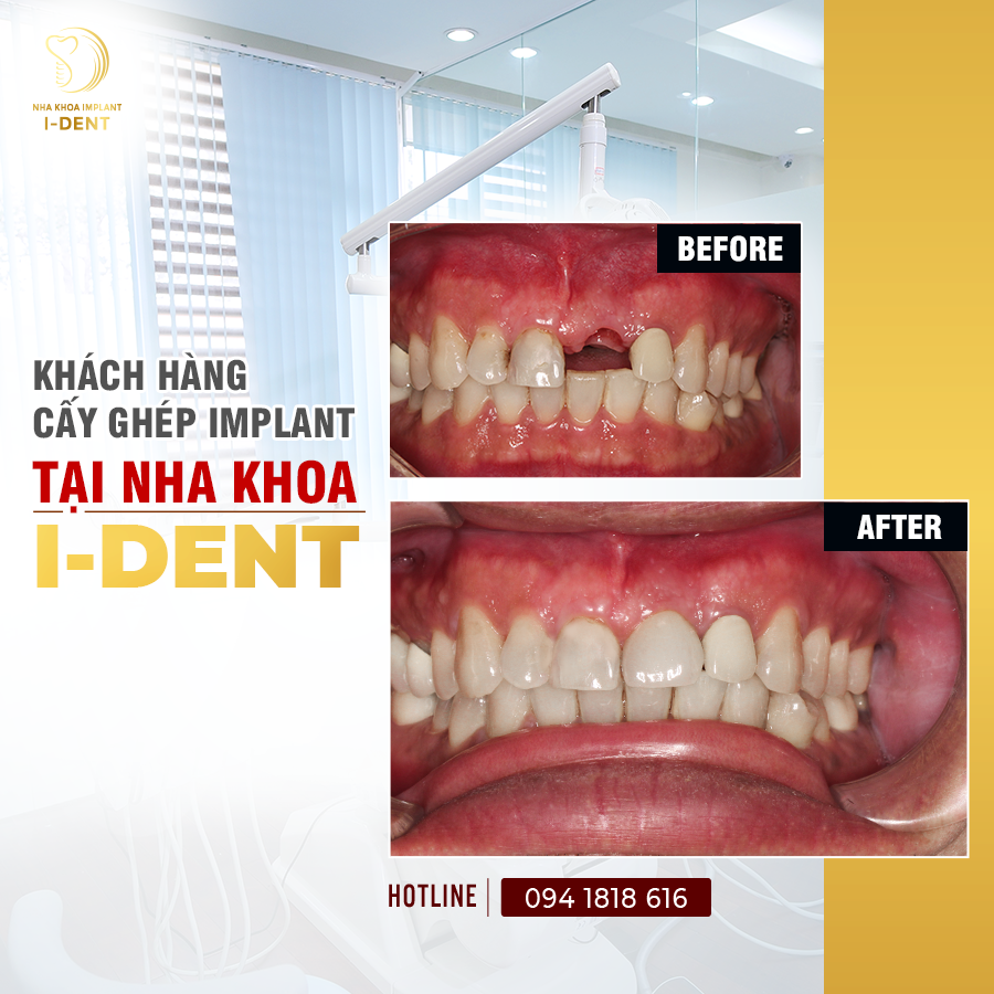 Nha Khoa I-Dent - Chuyên Sâu Cấy Ghép Implant ảnh 2