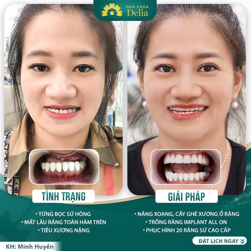 địa chỉ trồng răng implant uy tín nhất quận Hai Bà Trưng, Hà Nội