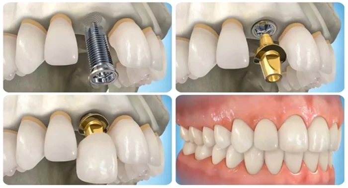 Địa chỉ trồng răng implant uy tín nhất quận Bình Thạnh, Tp HCM