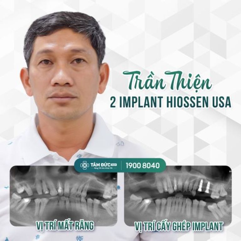 Viện Cấy Ghép Implant TÂM ĐỨC SMILE ảnh 2