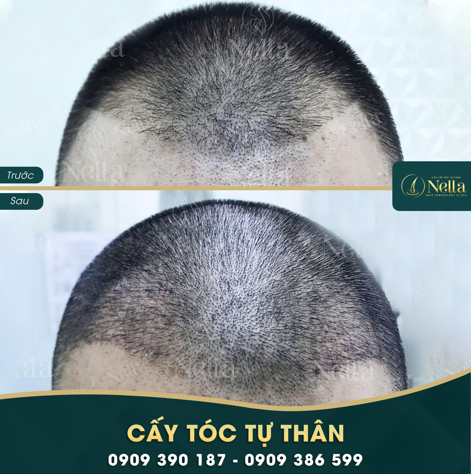 Viện Cấy Tóc Tự Thân Nella ảnh 1