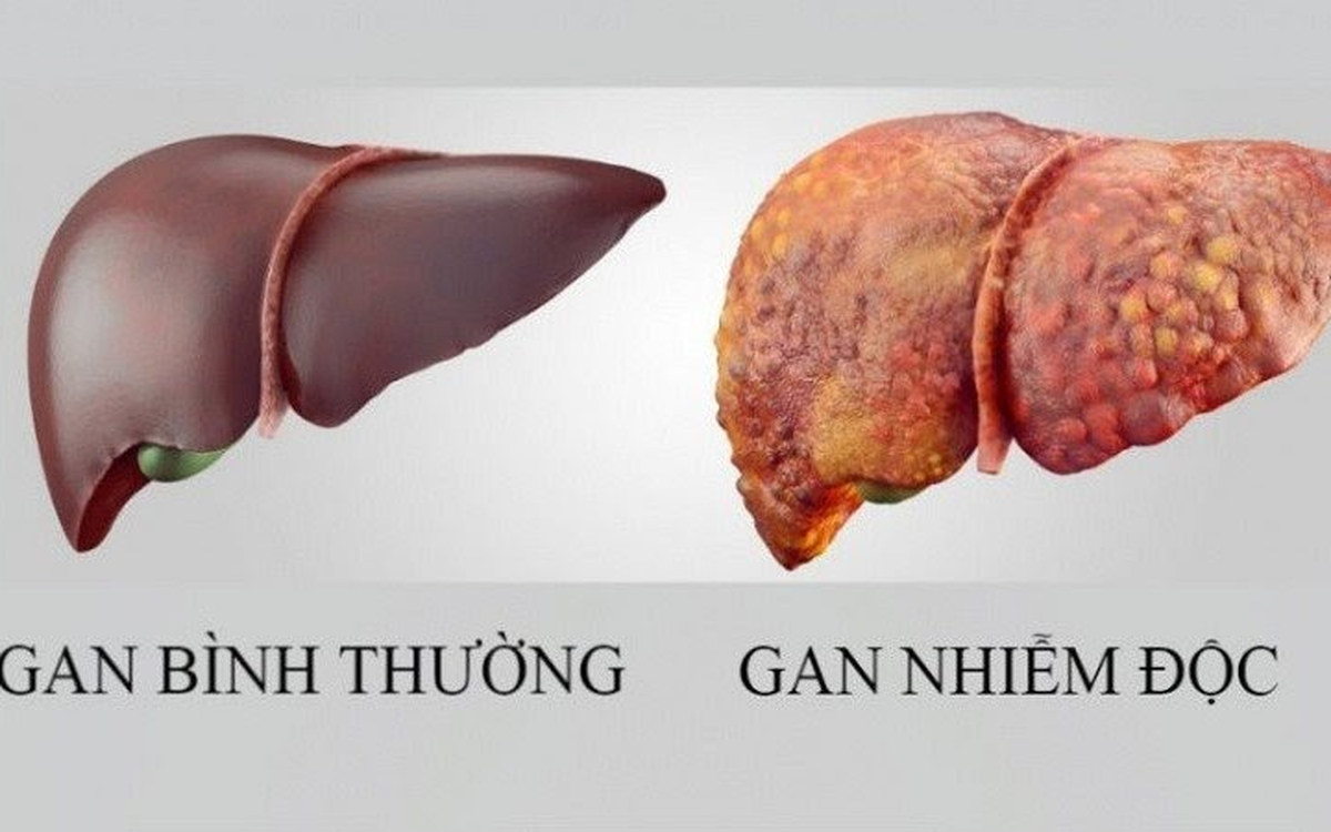 sản phẩm giải độc gan tốt nhất hiện nay